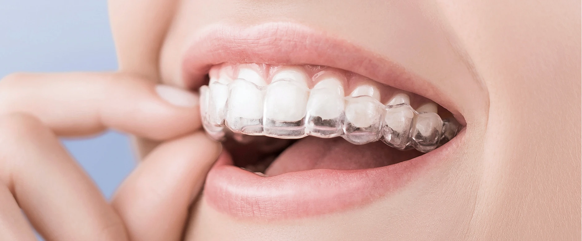 Traitement d’orthodontie invisible