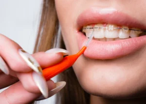 Traitement d'orthodontie multibagues